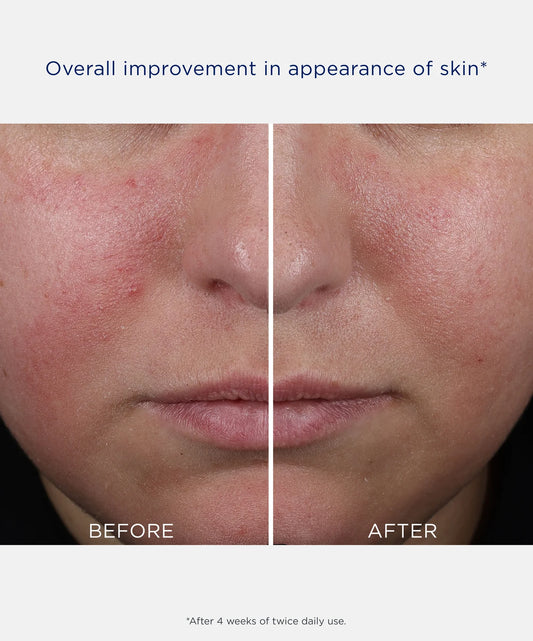 Neostrata Clarify Mandelic Clarifying Hydragel in 50ml bottle showing before and after skin results.