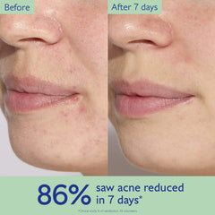Caudalie Vinopure Acne Serum in 30ml bottle, designed to treat and prevent blemishes, with a clear dropper and product label.